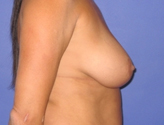 Patient # 54028 Before Photo # 5